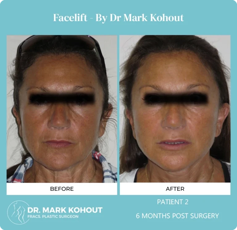 Patient 2 - 6 Months Post Surgery