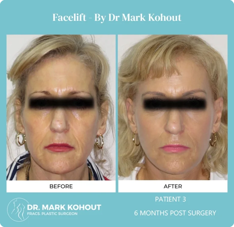 Patient 3 - 6 Months Post Surgery