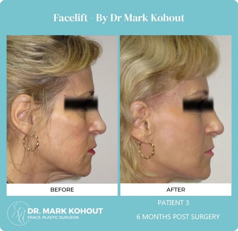 Patient 3 - 6 Months Post Surgery