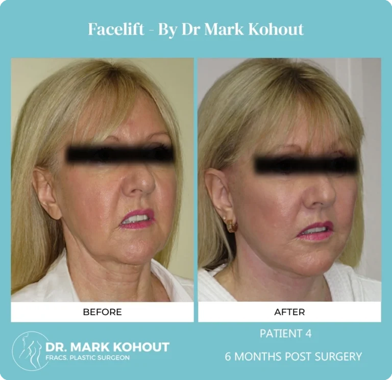 Facelift Before and After Photo Sample 6 MOnths Post Op