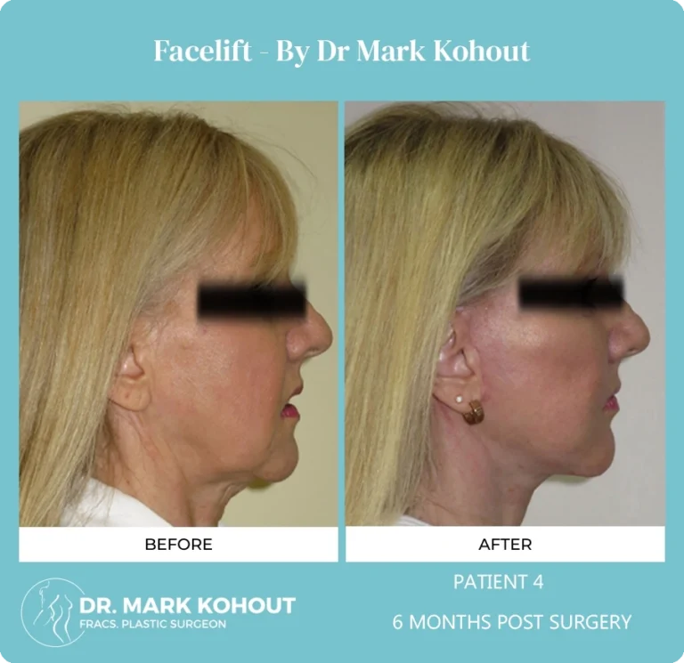 Patient 4 - 6 Months Post Surgery