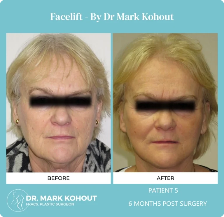 Patient 5 - 6 Months Post Surgery