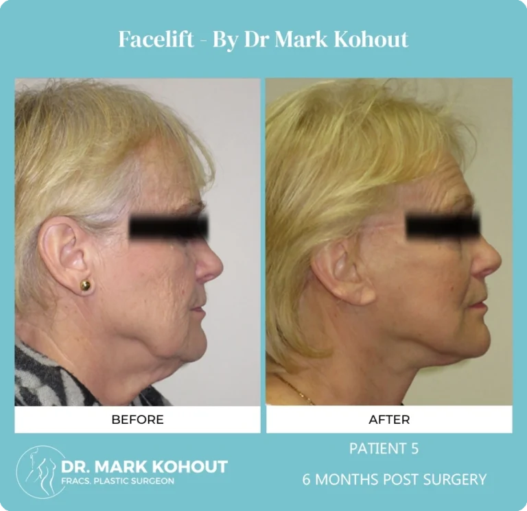 Patient 5 - 6 Months Post Surgery