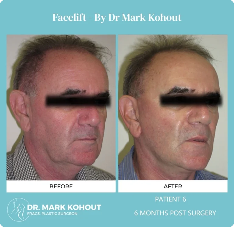 Patient 7 - 6 Months Post Surgery