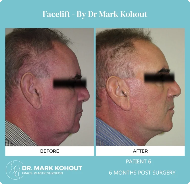 Patient 7 - 6 Months Post Surgery