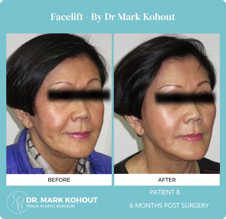 Patient 9 - 6 Months Post Surgery
