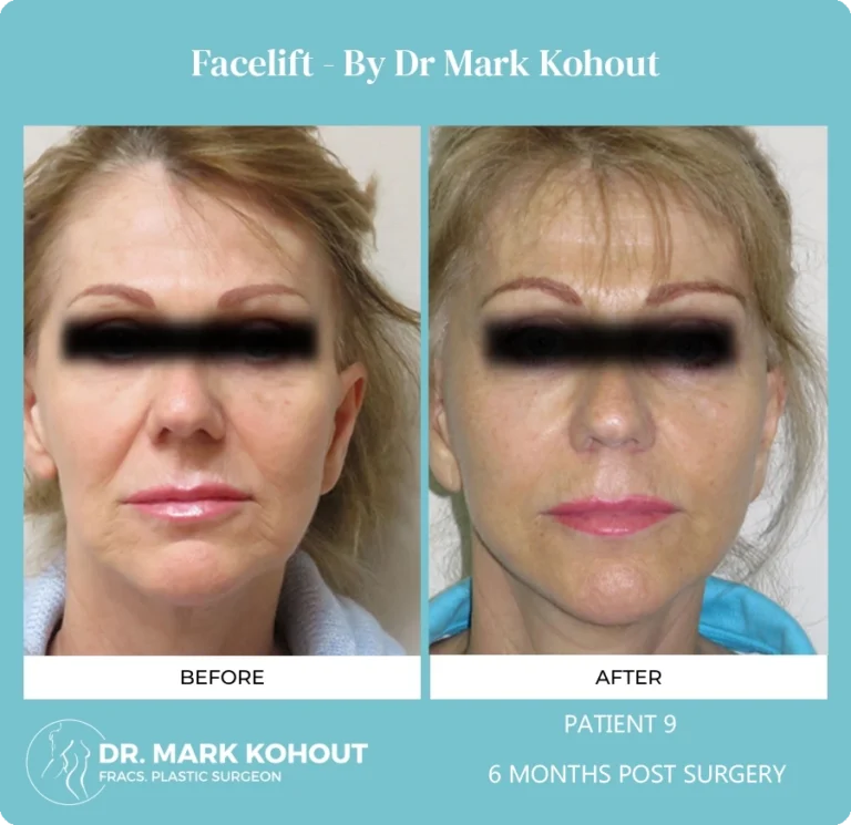 Patient 10 - 6 Months Post Surgery