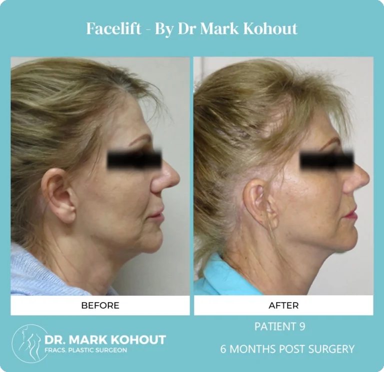 Patient 10 - 6 Months Post Surgery