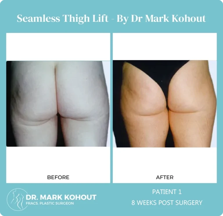 Thigh Lift Patient 1 back