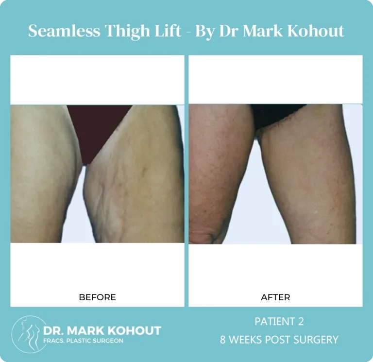 Thigh Lift Patient 2 front