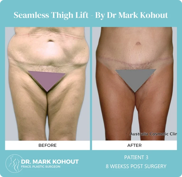 Thigh Lift Patient 3 front