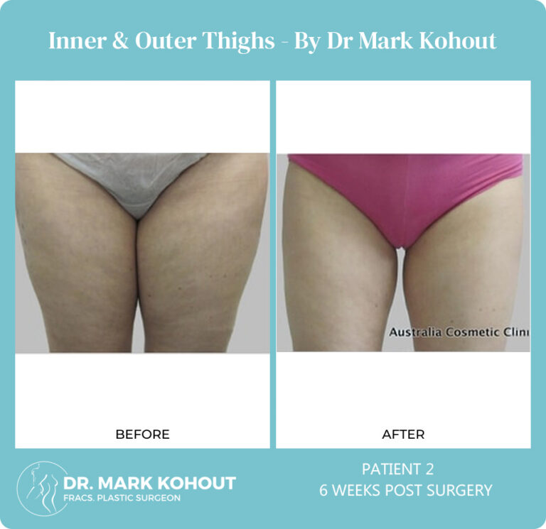 Thigh Liposuction - Dr Mark Kohout