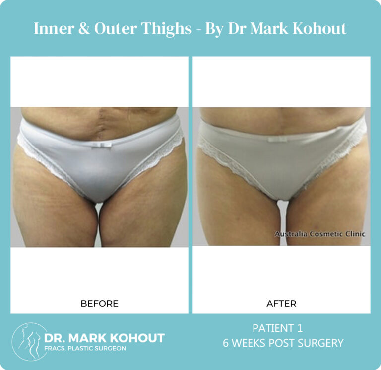 Thigh Liposuction - Dr Mark Kohout