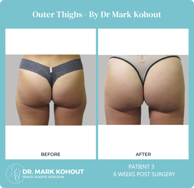 Thigh Liposuction - Dr Mark Kohout