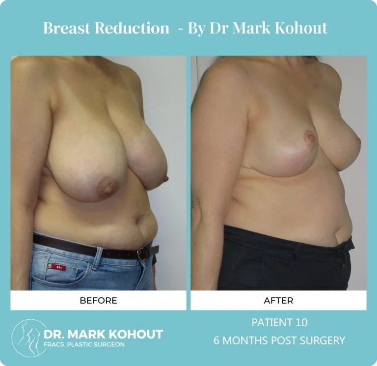 Breast Reduction Patient 10 45