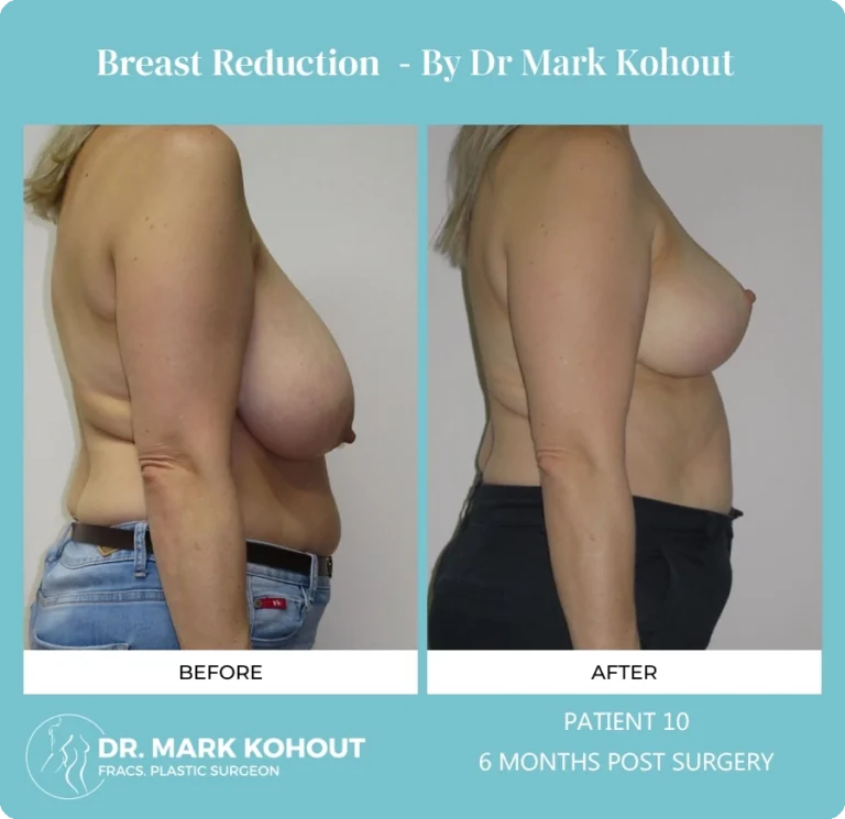Breast Reduction Patient 10 side