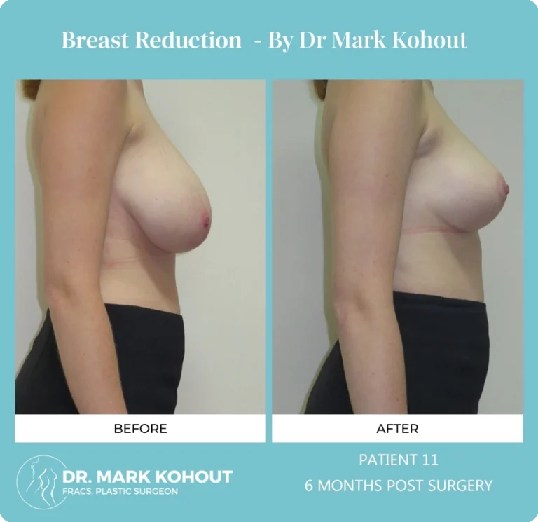 Breast Reduction Patient 11 side