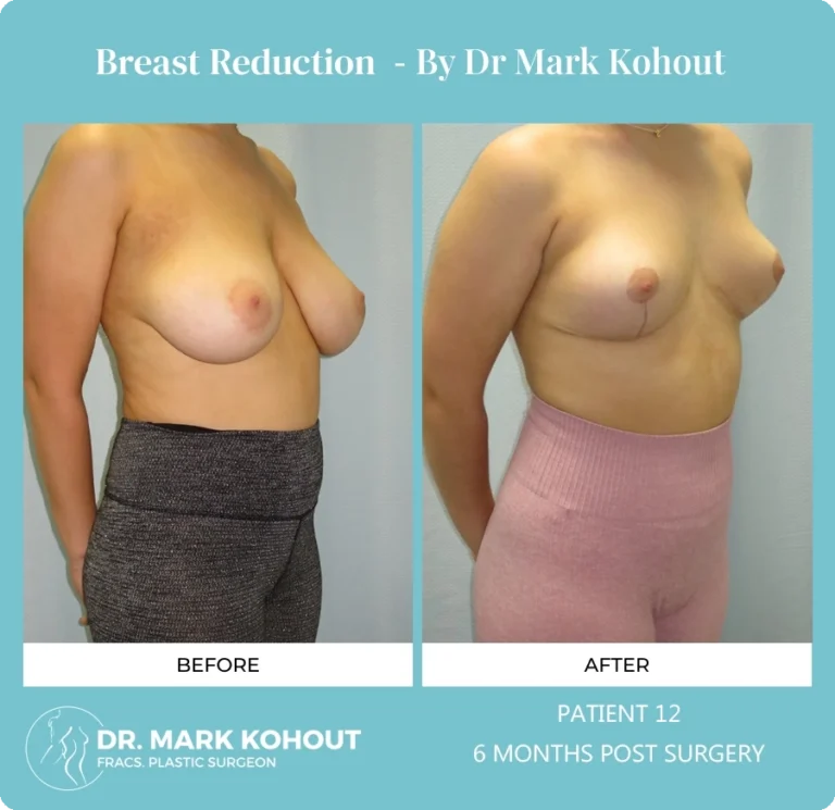 Breast Reduction Patient 12 45