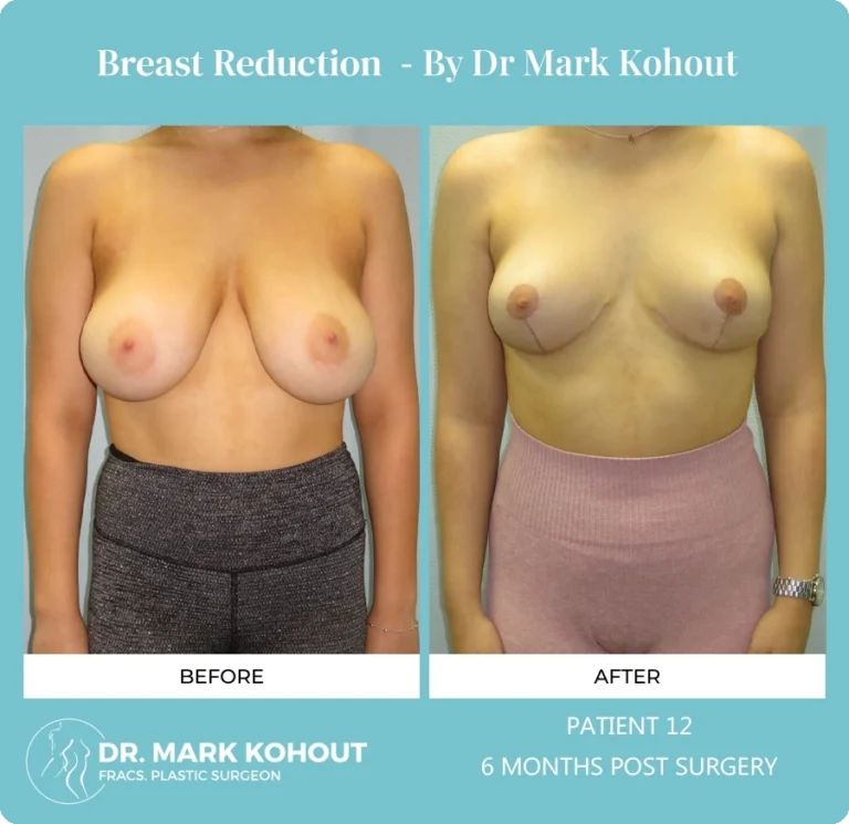 Breast Reduction Patient 12 front