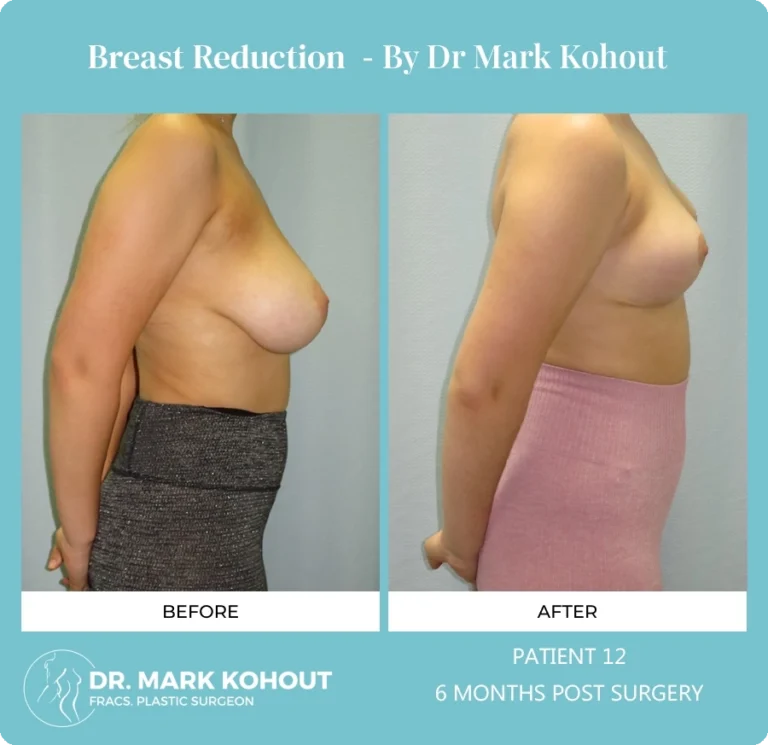 Breast Reduction Patient 12 side