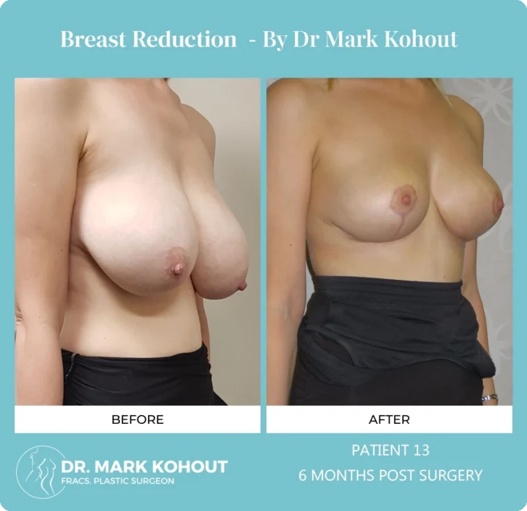 Breast Reduction Patient 13