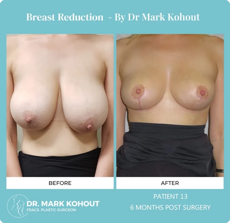 Breast Reduction Patient 13 front