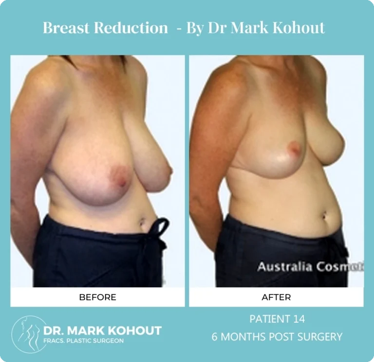 Breast Reduction Patient 14 45