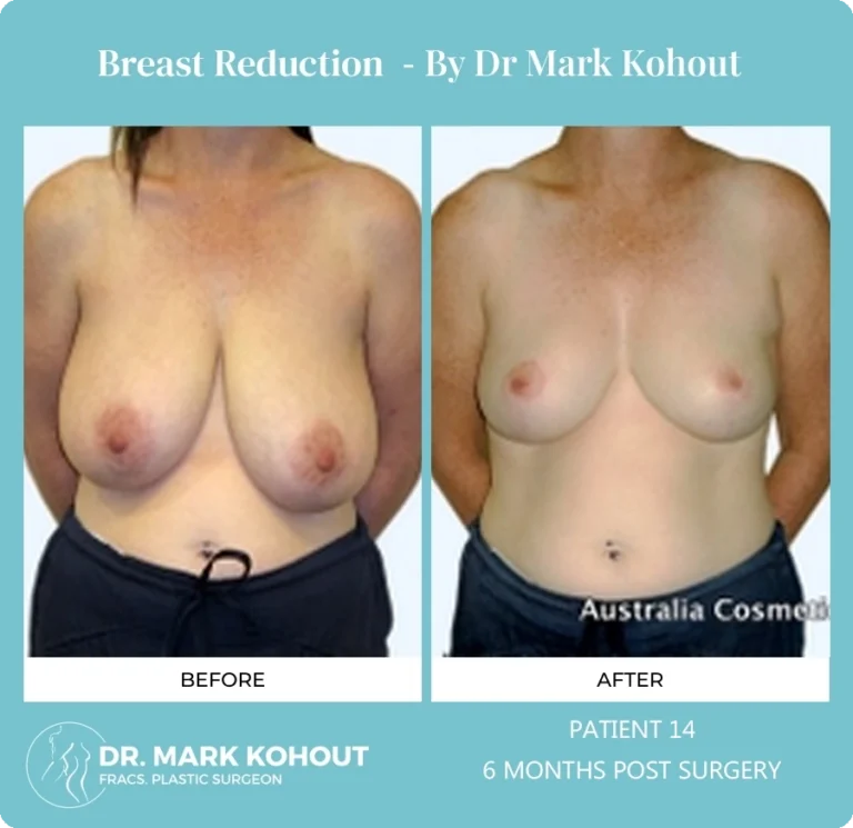 Breast Reduction Patient 14 front