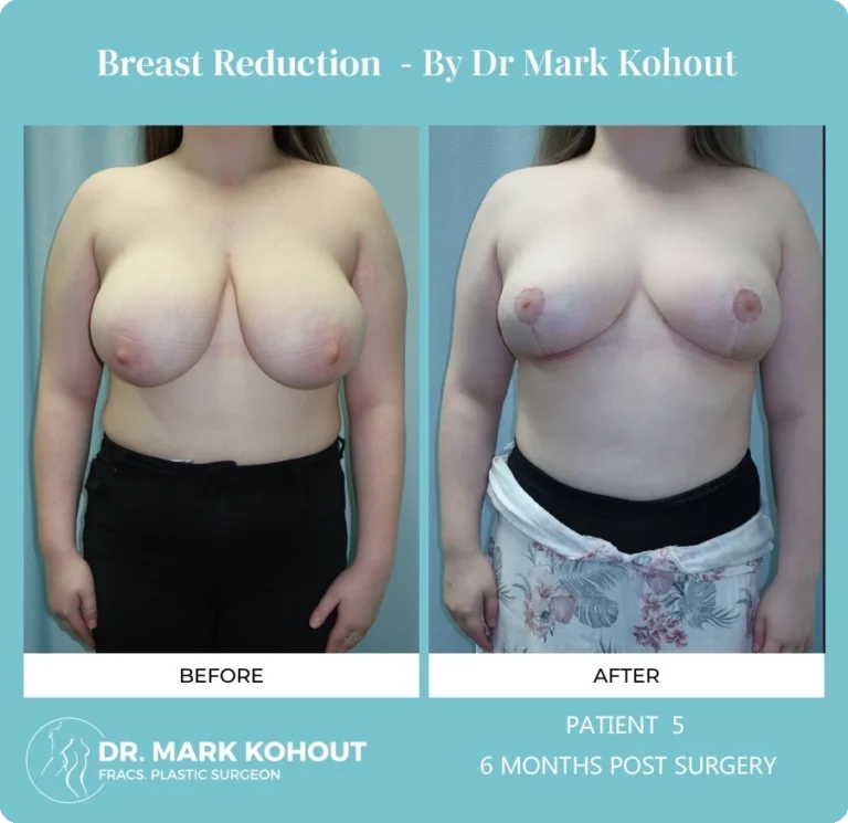 Breast Reduction Patient 5 front