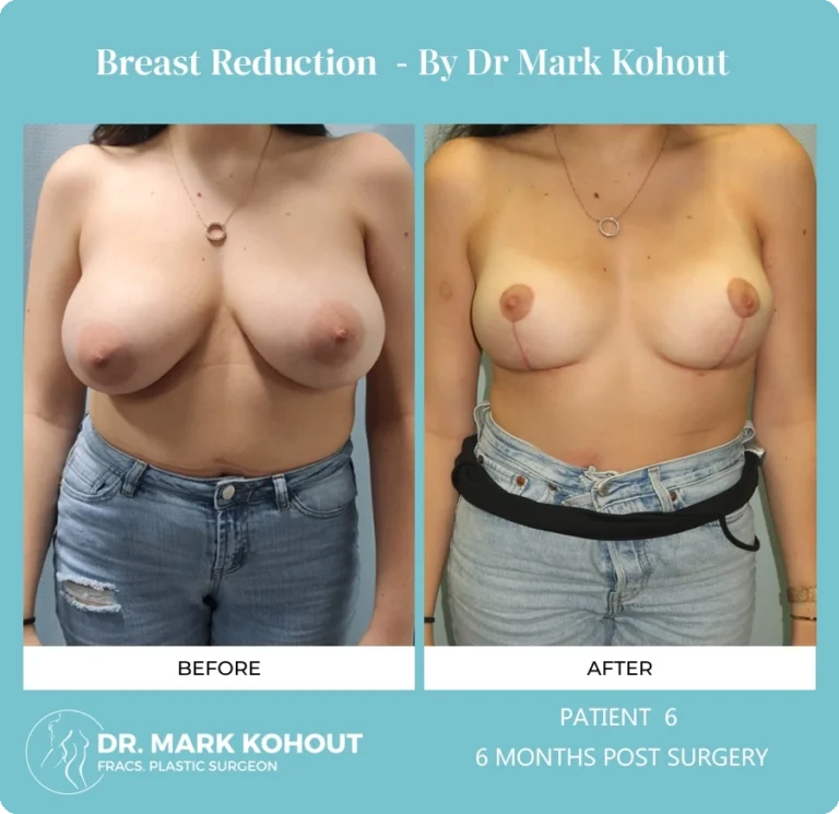 Breast Reduction Patient 6 front