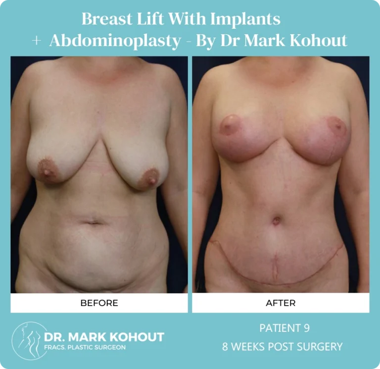 Patient 9 - 8 Weeks Post Surgery