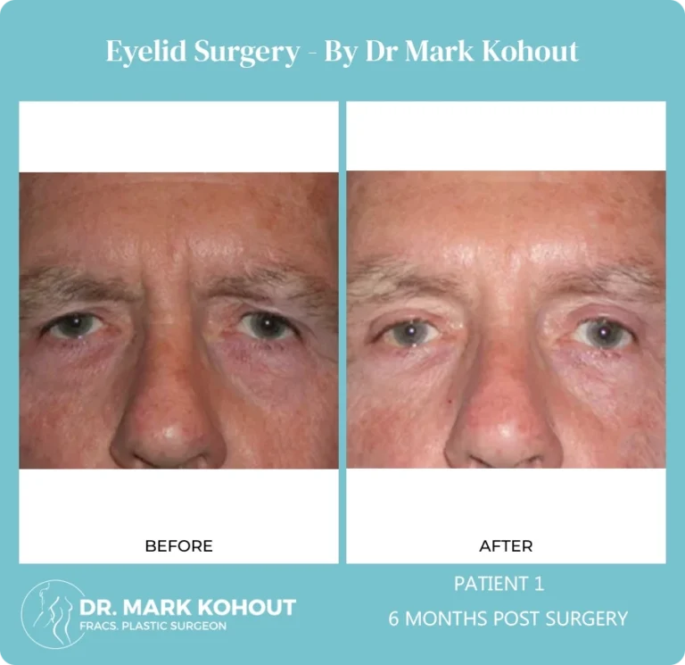 Eyelid Surgery Patient 1 front