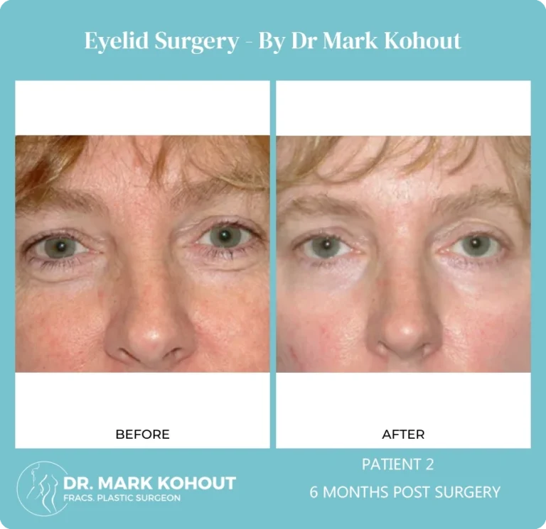 Eyelid Surgery Patient 2 front