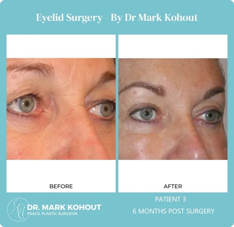 Eyelid Surgery Patient 3 45