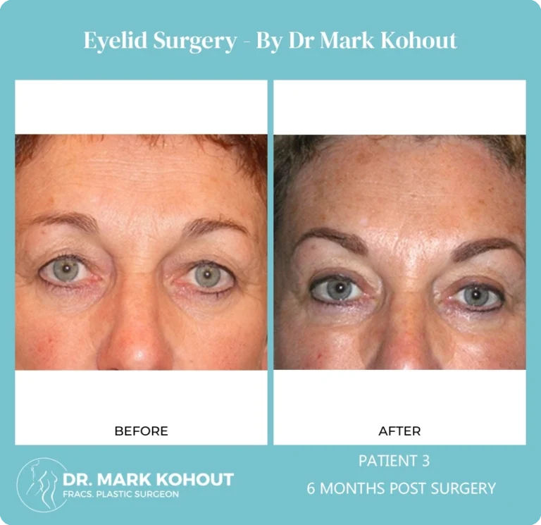 Eyelid Surgery Patient 3 front