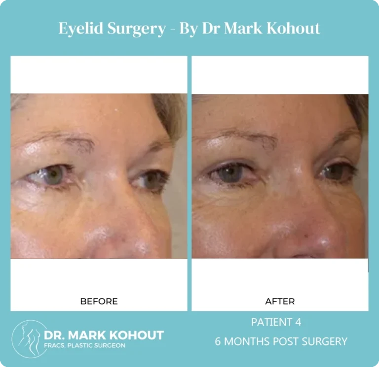 Eyelid Surgery Patient 4 45