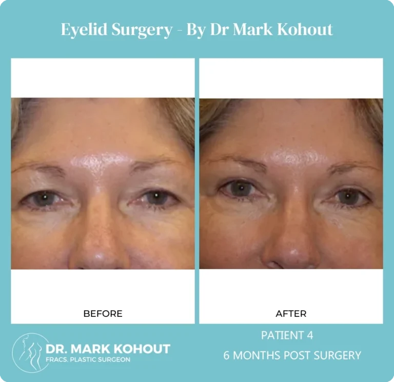 Eyelid Surgery Patient 4 front