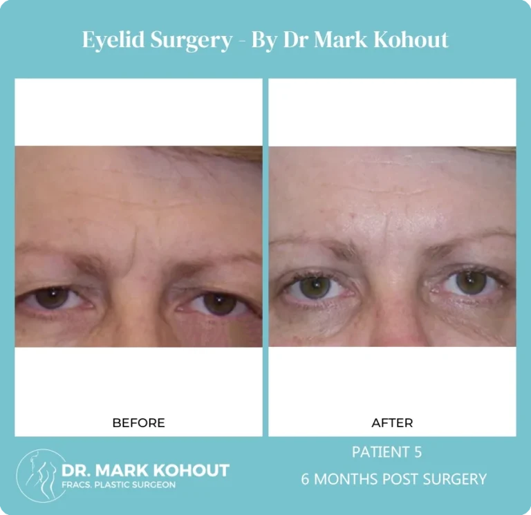Eyelid Surgery Patient 5 front