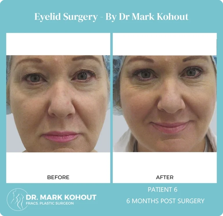 Eyelid Surgery Patient 6 front