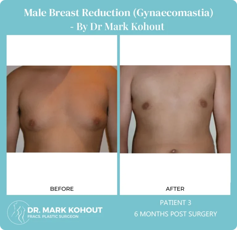 Gynaecomastia Patient 3 front