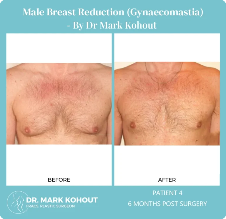 Gynaecomastia Patient 4 front