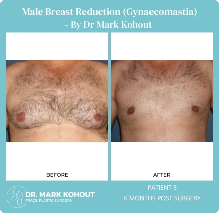 Gynaecomastia Patient 5 front