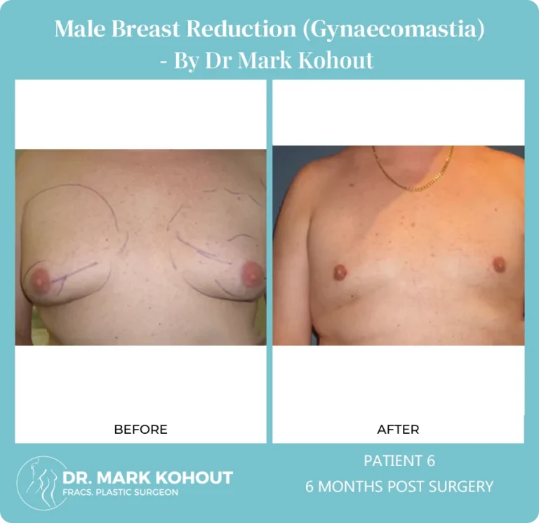 Gynaecomastia Patient 6 front
