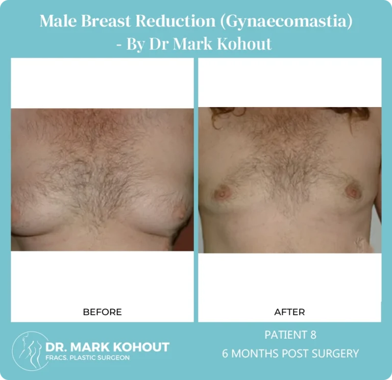 Gynaecomastia Patient 8 front