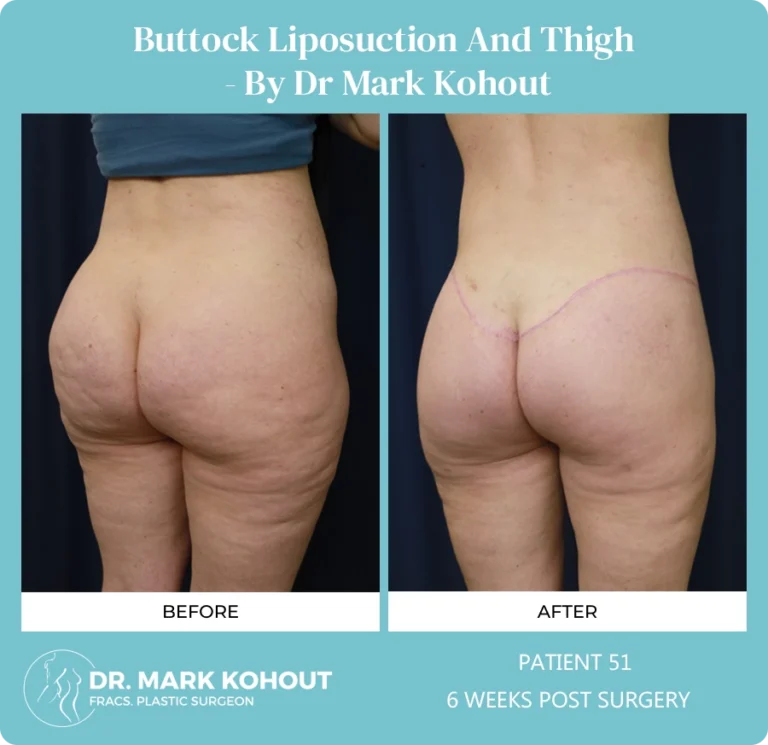 Liposuction Before and After Photos - Buttock and Thigh
