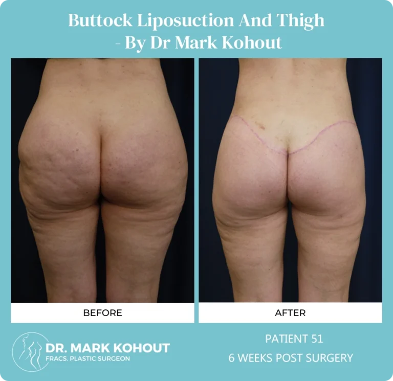 Liposuction Before and After Photos - Buttock and Thigh