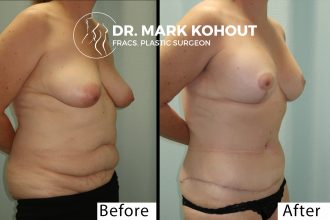 Abdominoplasty-and-Breast-lift-Mastopexy-by-Dr-Kohout 1008