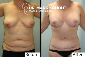 Abdominoplasty-and-Breast-lift-Mastopexy-by-Dr-Kohout 1008