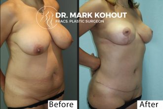 Abdominoplasty-and-Breast-lift-Mastopexy-by-Dr-Kohout 1009