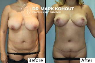 Abdominoplasty-and-Breast-lift-Mastopexy-by-Dr-Kohout 1009